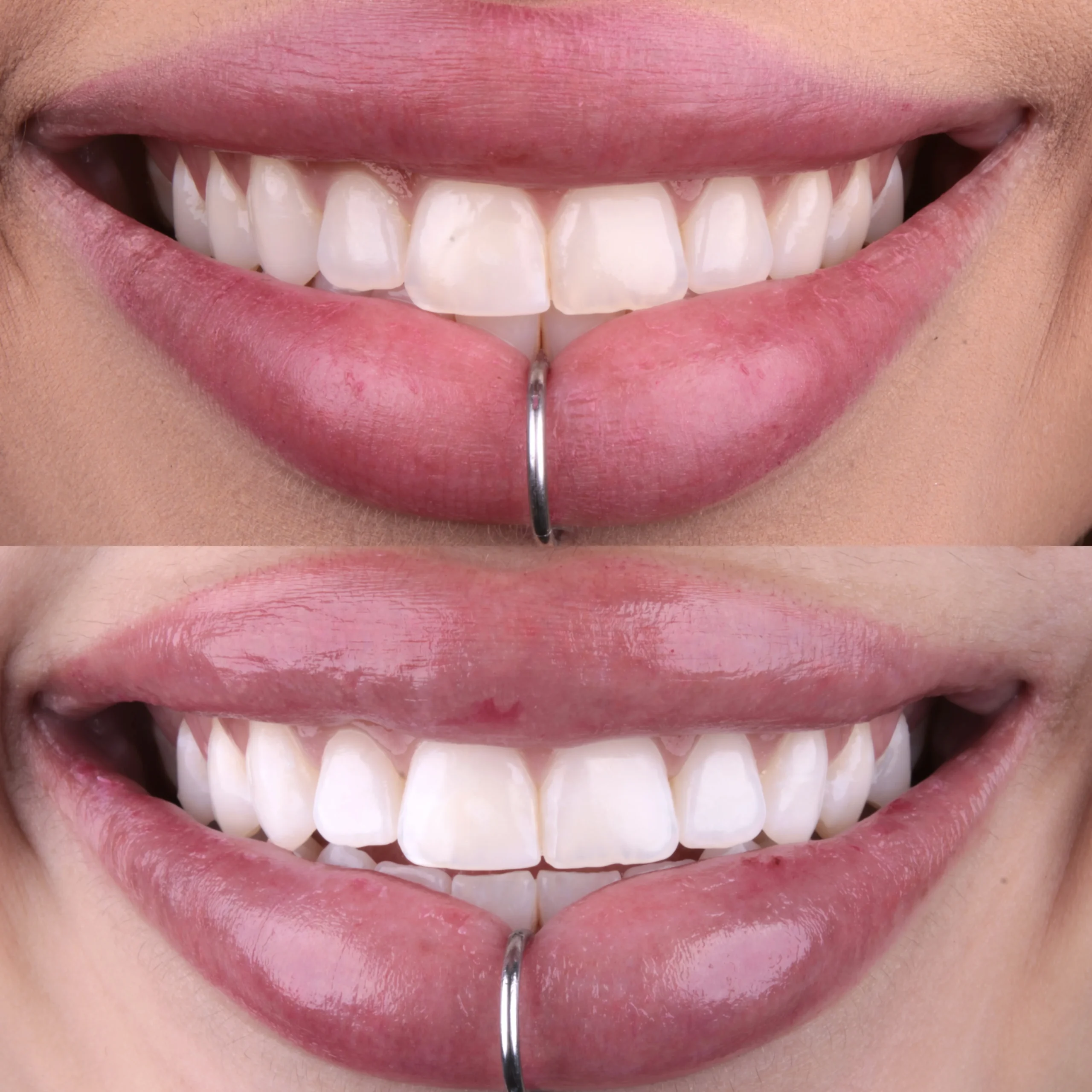 Clareamento dental
