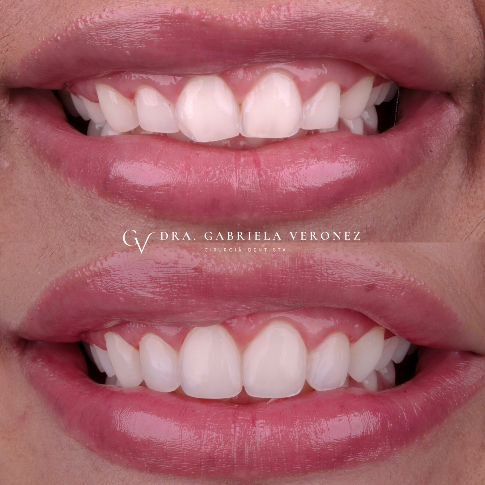 Facetas em resina composta, antes e depois, conduzido pela Dra. Gabriela Veronez