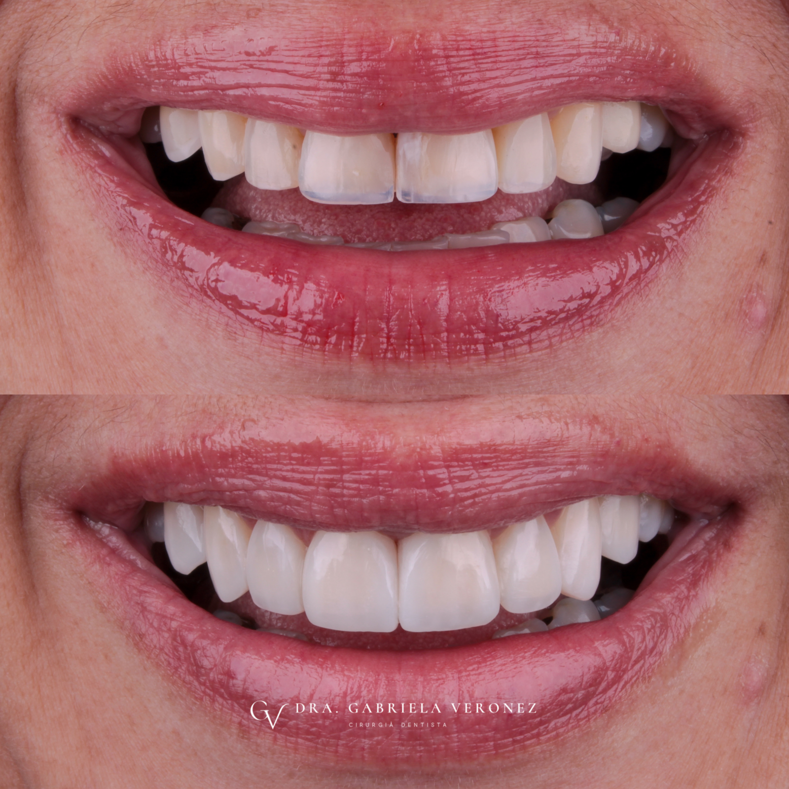 Facetas em resina composta, antes e depois, conduzido pela Dra. Gabriela Veronez